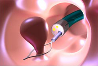 Imagen destacada - LESIONES INDICE DEL CÁNCER COLORRECTAL